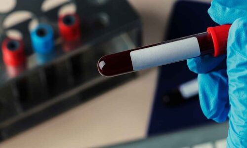 Coleta de sangue automatizada usa robô que acerta veia em quase 100% dos casos